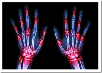 Rheumatoid Fargo ND Arthritis Solutions