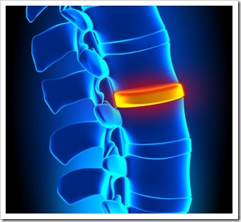 Herniated Disc and Back Pain Fargo ND